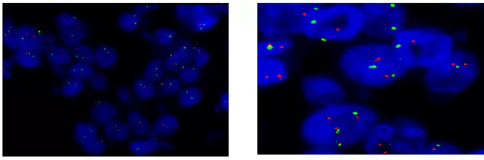 fish技术可以通过检测与her2基因相关的荧光dna标记的探针信号数量来