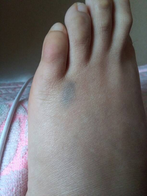 脚又无端端青了