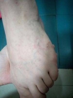化疗完脚上长红疹子