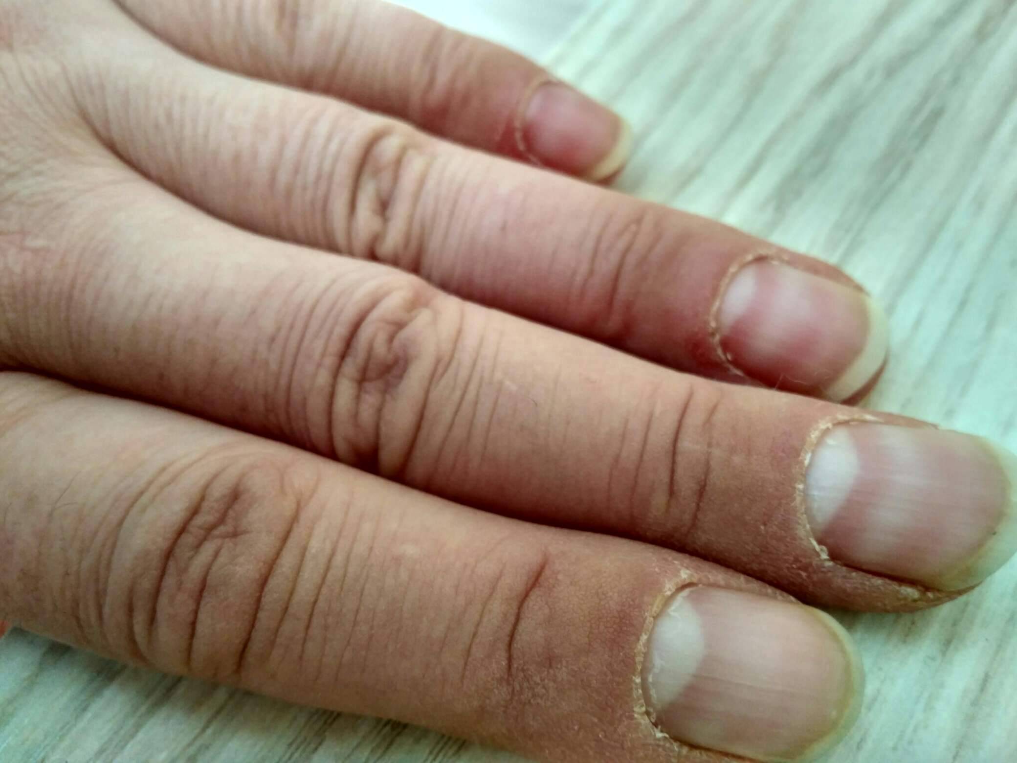 肾病指甲的症状图片图片