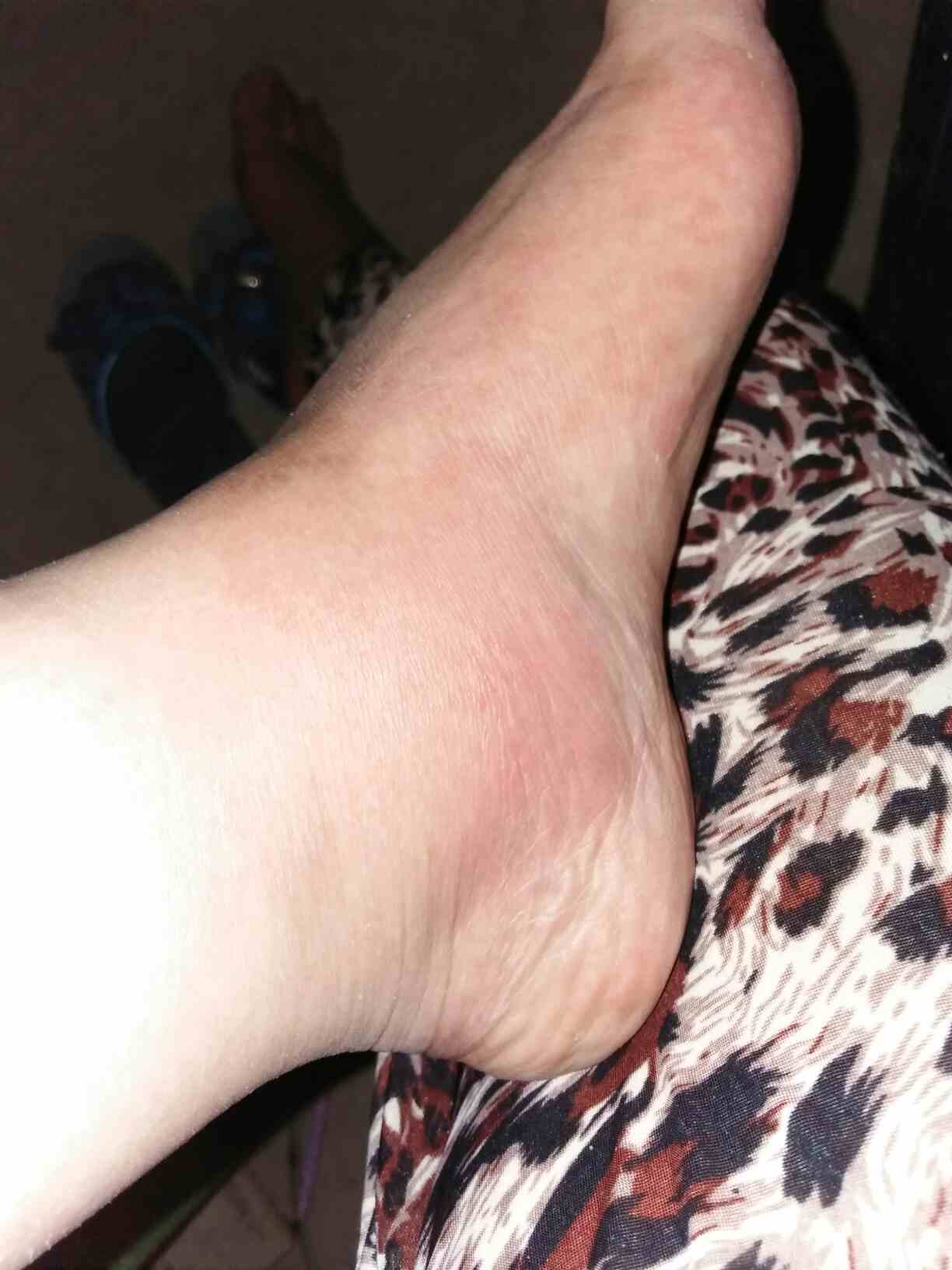女生左脚脚肿的图片图片