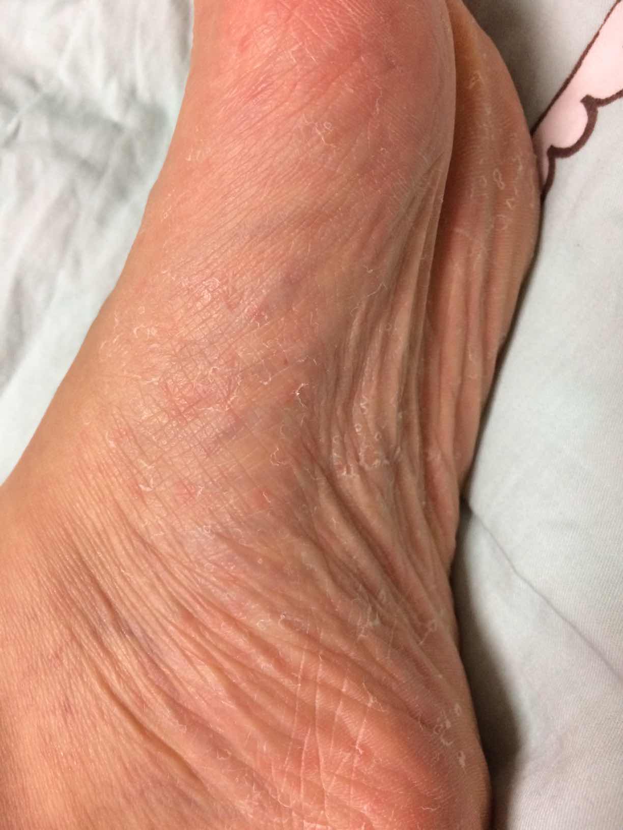 脚上有红斑是什么原因图片