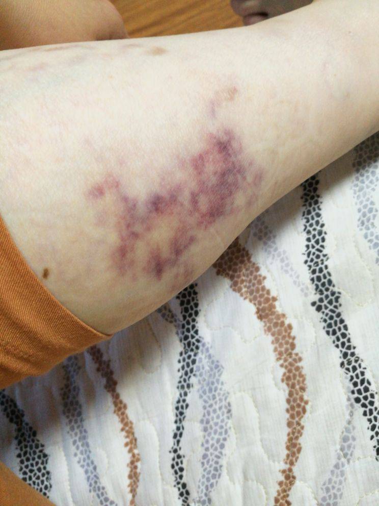 腿部血栓发紫早期图片图片