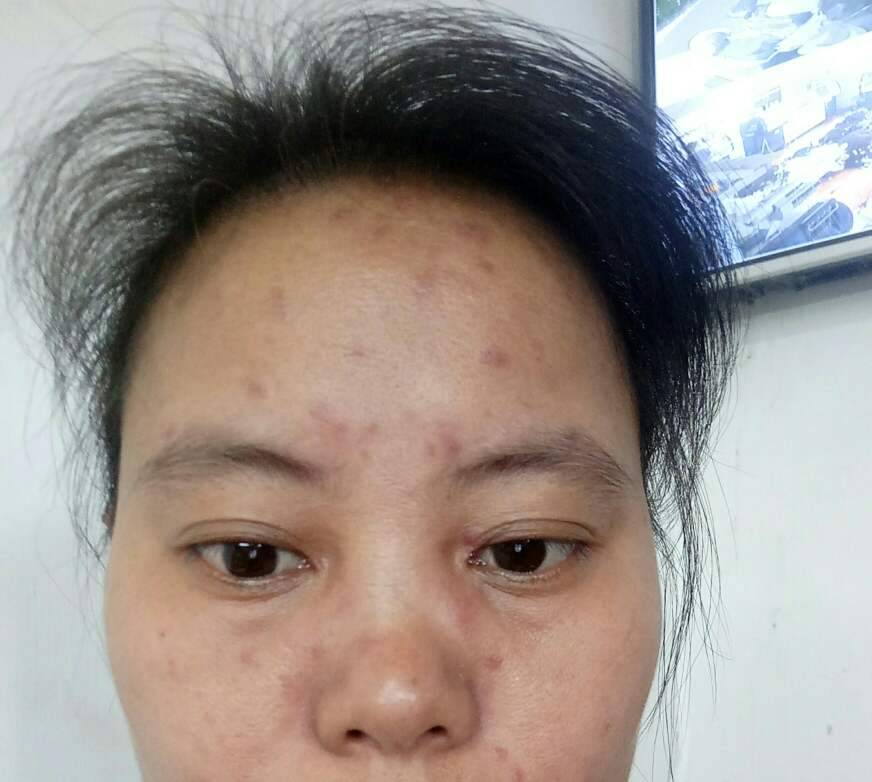 脸上这是长痘还是长斑呢