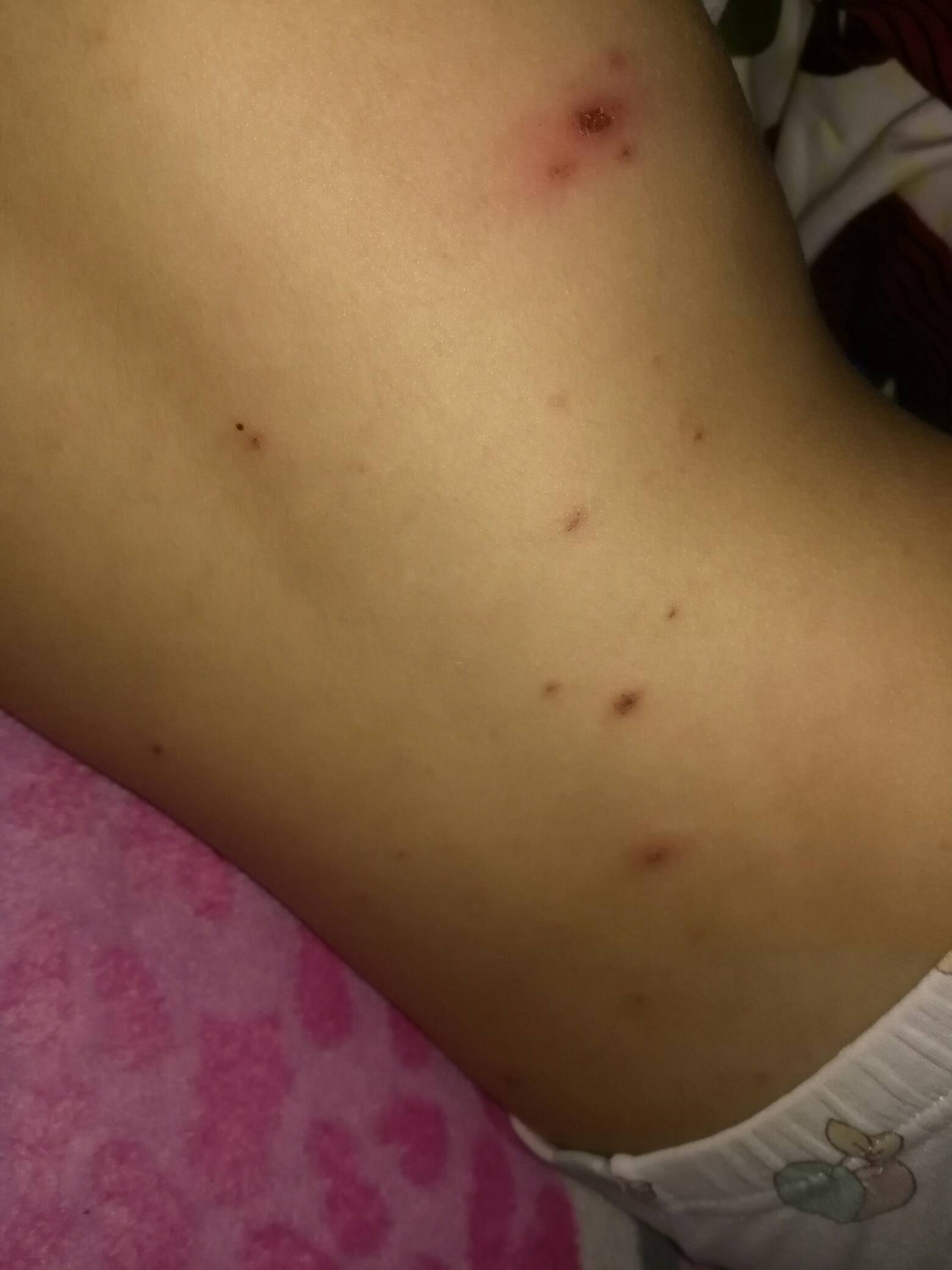 水痘的早期症状与护理