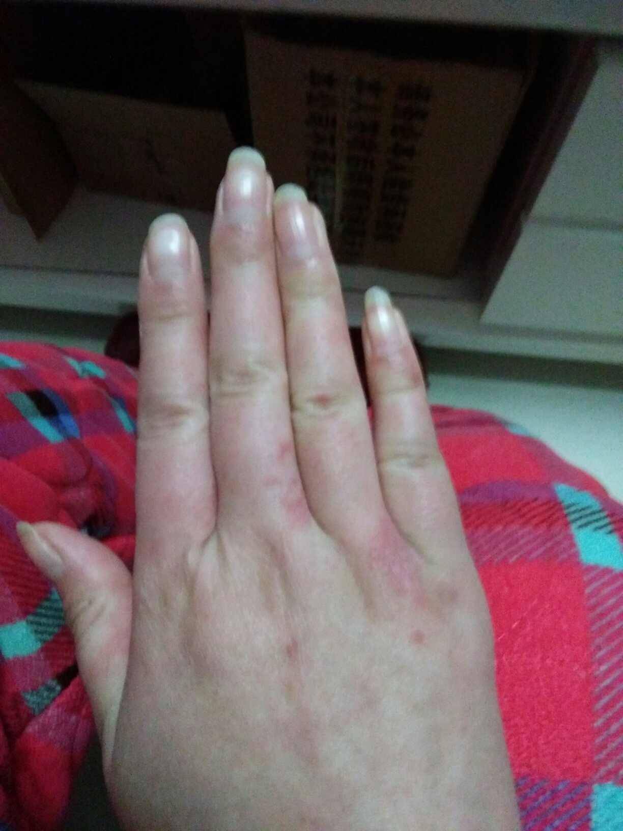 我这是血管炎吗