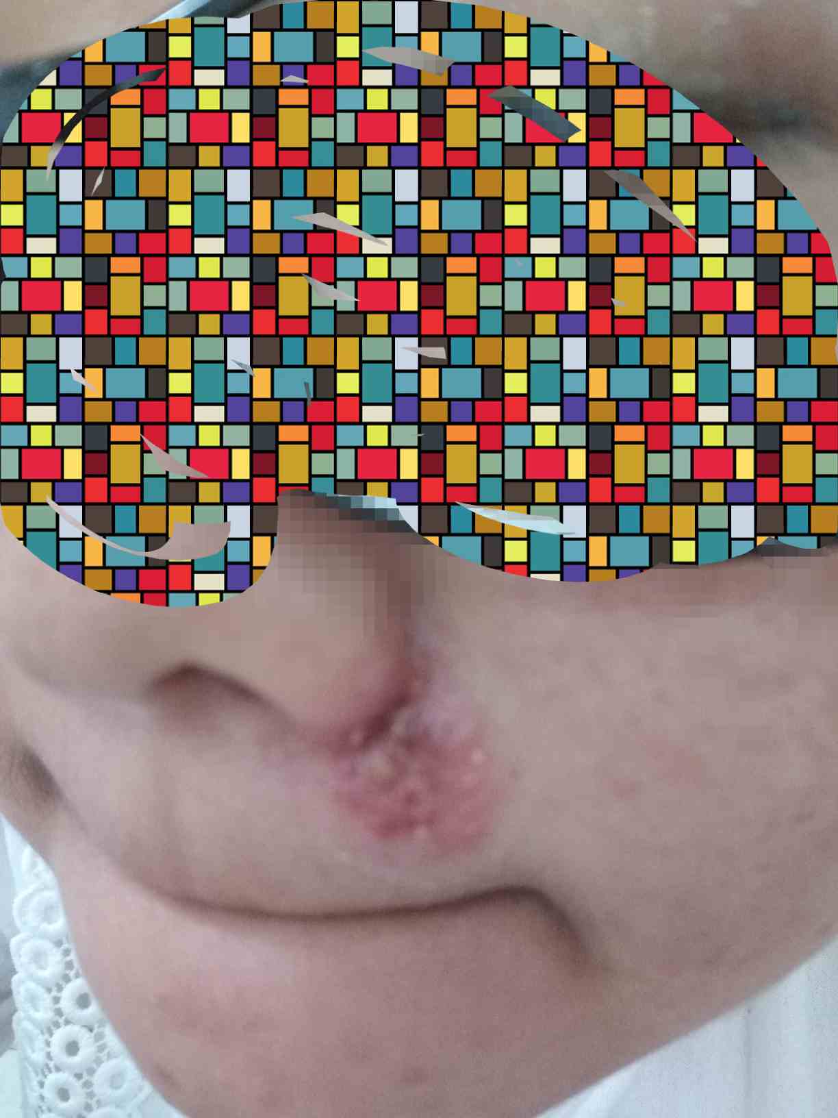 鼻子口疱疹的症状图片图片