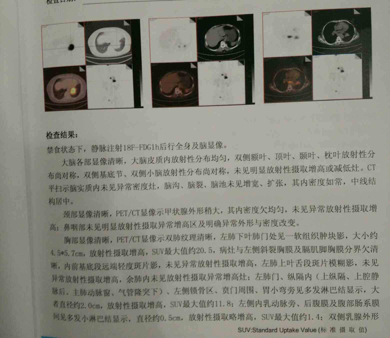 请大家帮忙看看妈妈的petct报告