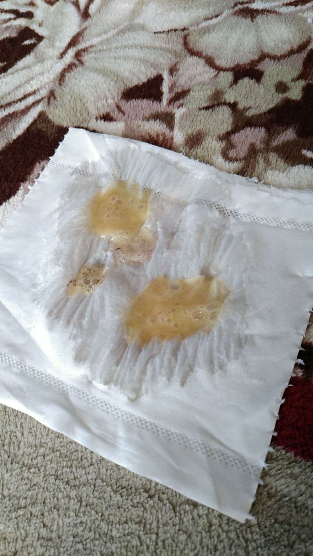 肺鳞癌中央型四次化疗后咳嗽有浓痰