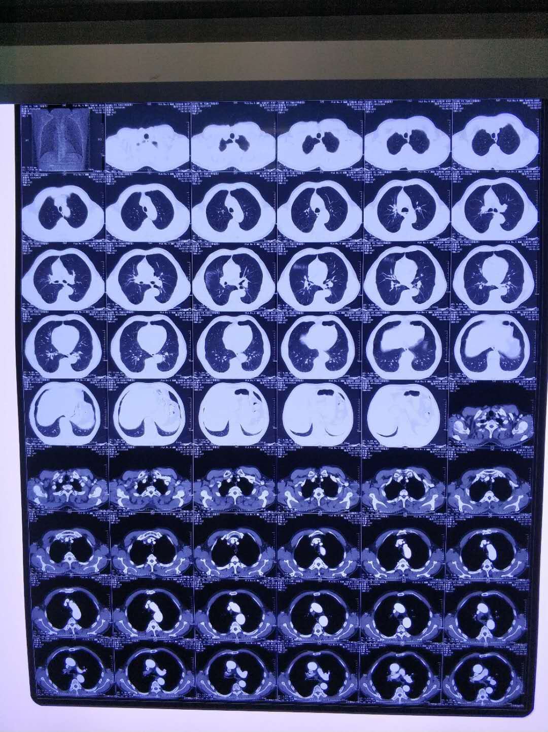 問醫生板塊和留言區還是上傳不了太多片子,呼叫陳醫生-肺癌康復圈