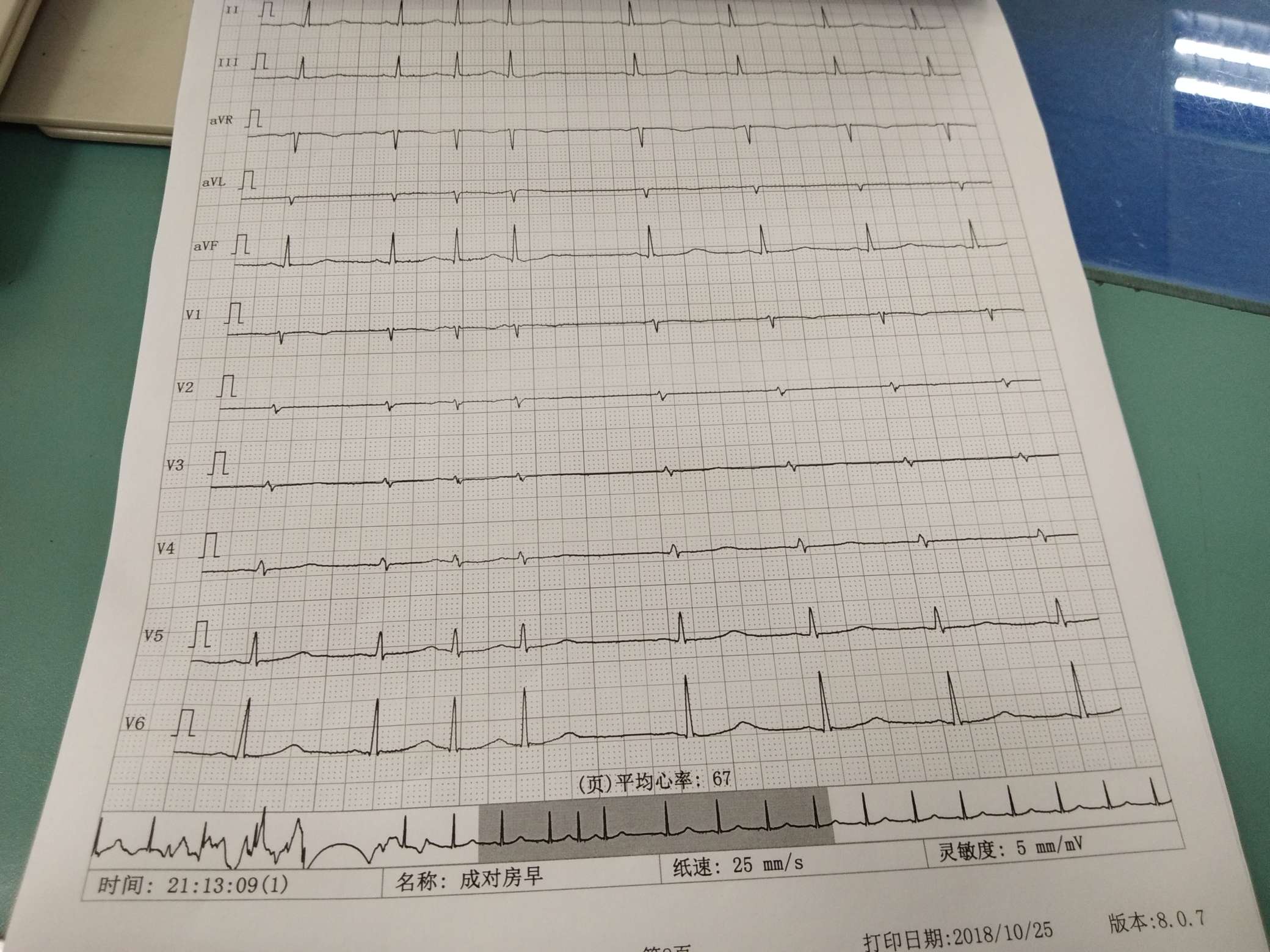上学时候最怕心电图. - 觅健∣陪伴 互助 健康