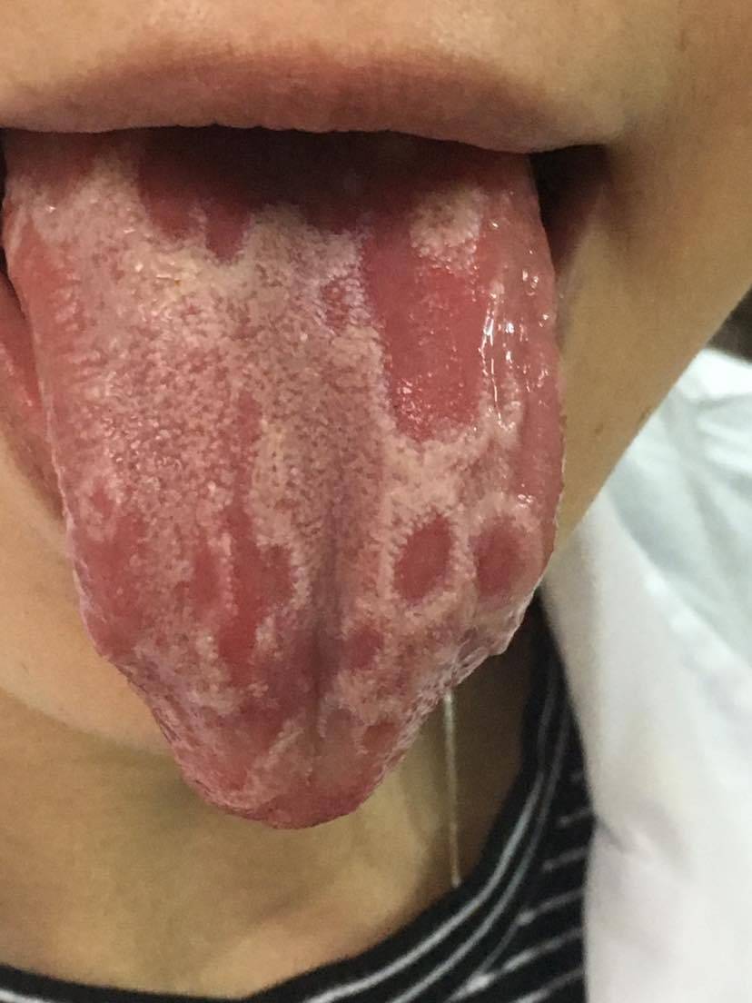 舌头上有红斑图片
