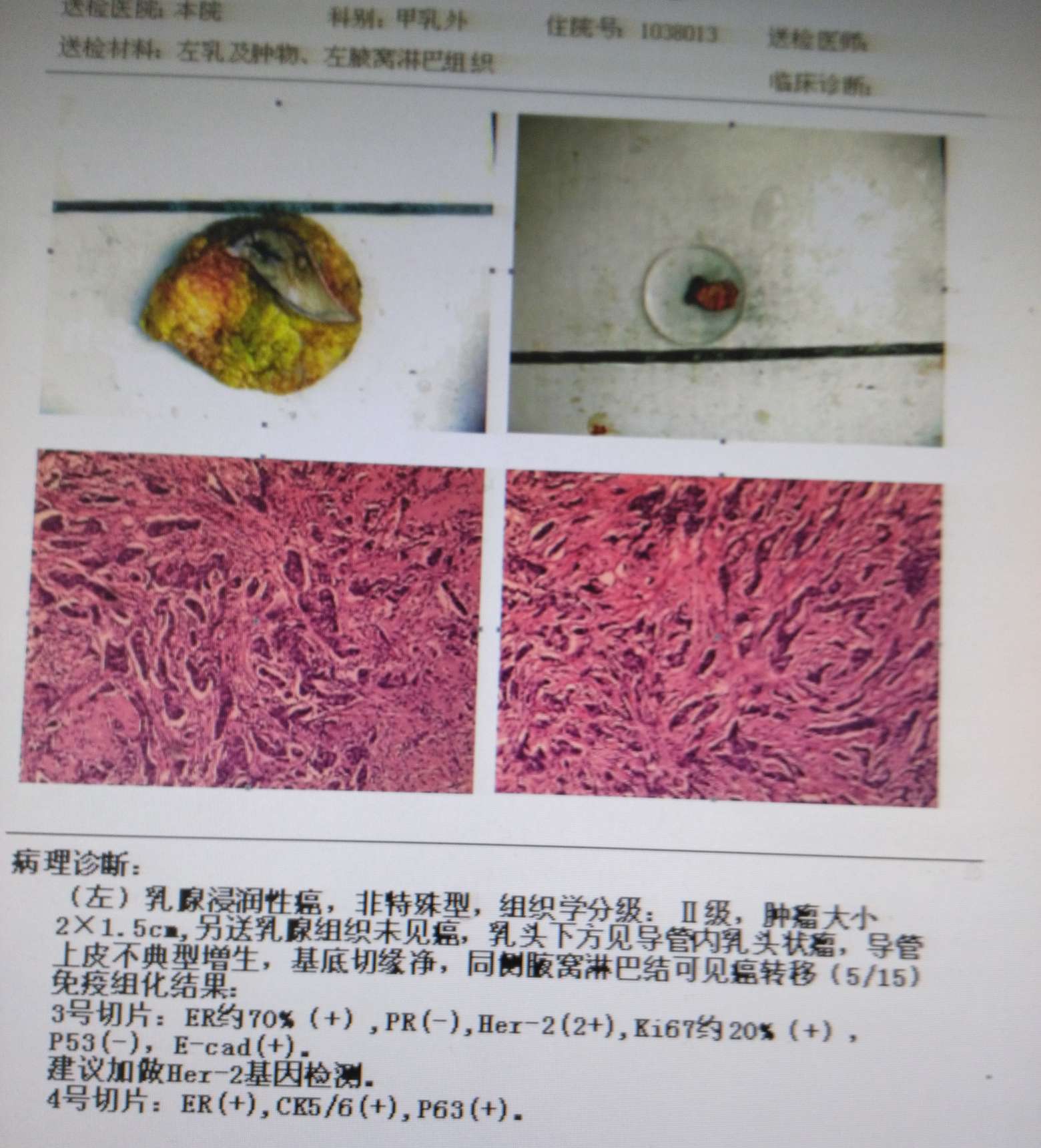 帮忙看下妈妈这个病理报告吗