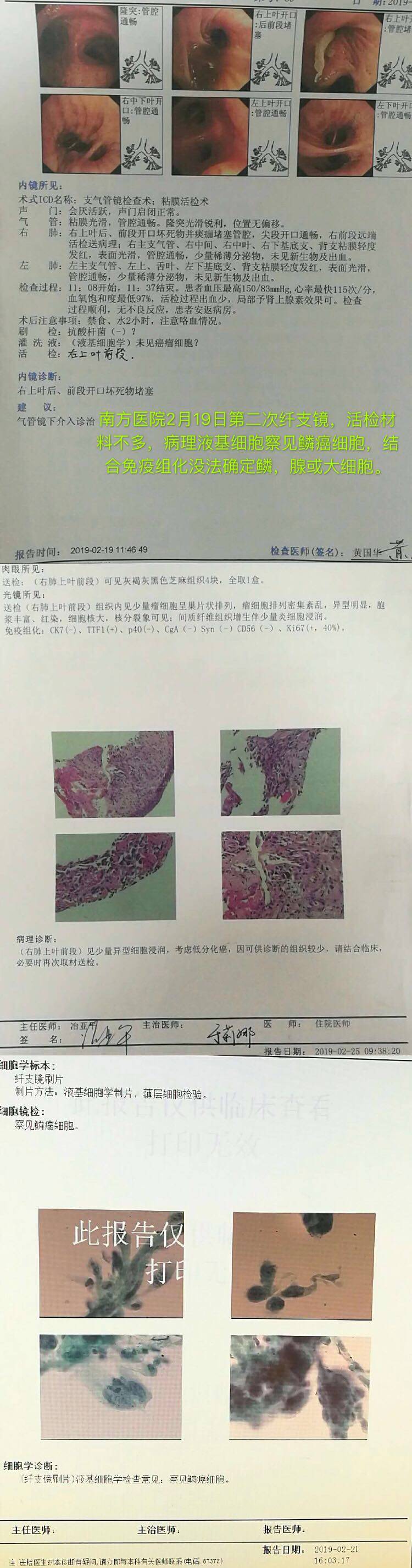 复大肿瘤医院结果:3月14号经皮穿刺活检结果低分化腺癌 免疫组化为