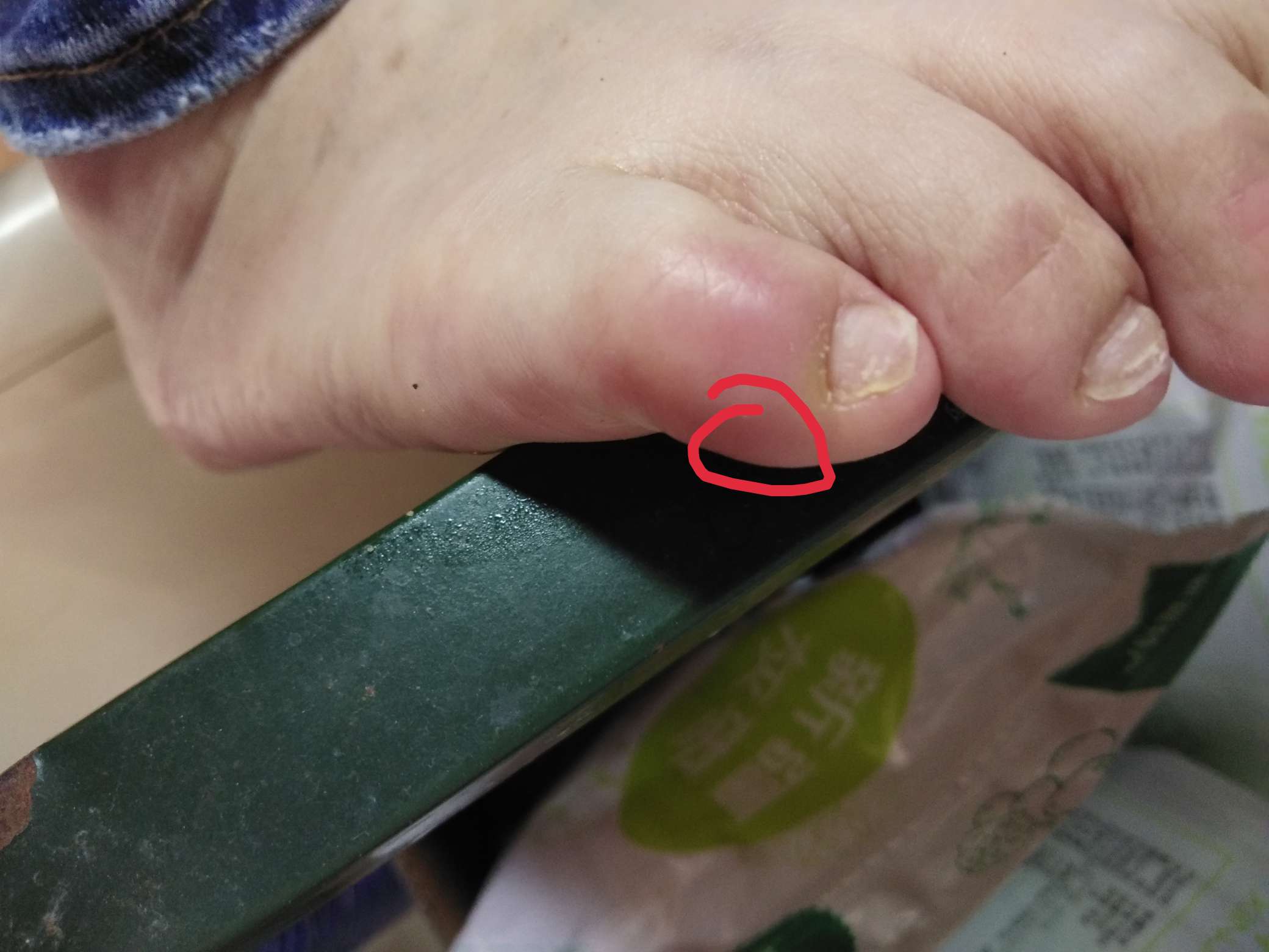 最近小母脚趾痛走路