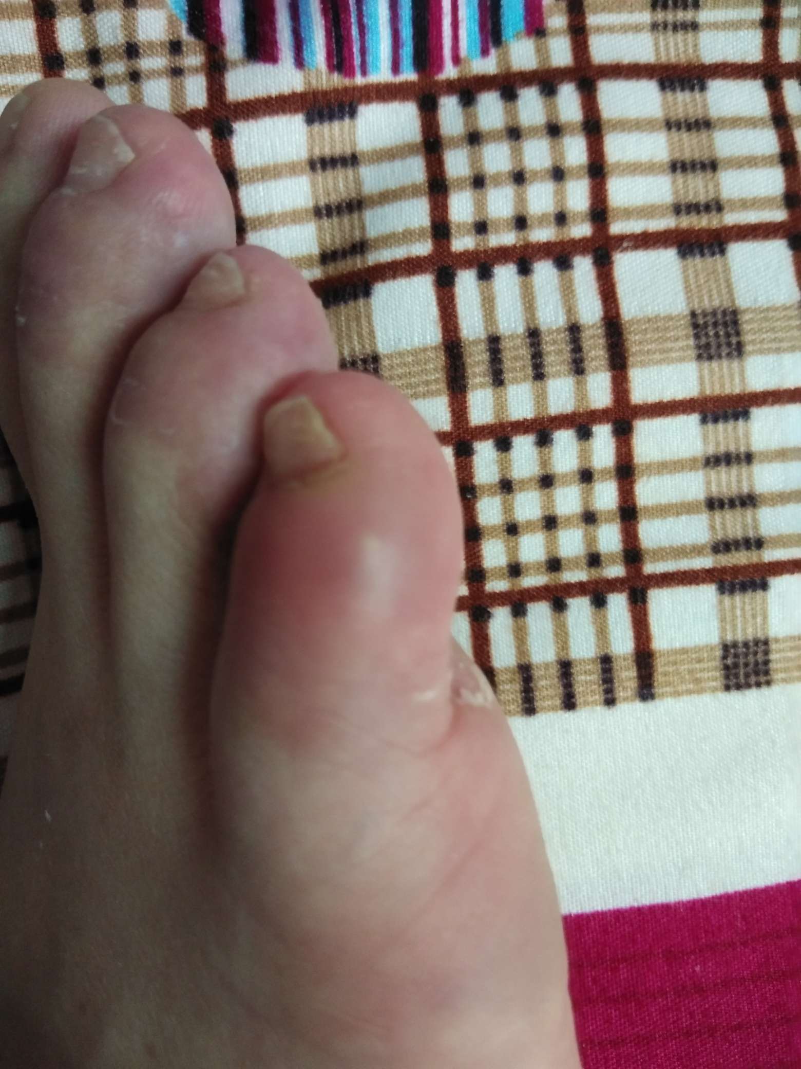 最近小母脚趾痛又红又
