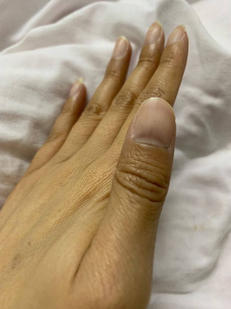 2疗后指甲黑了皮