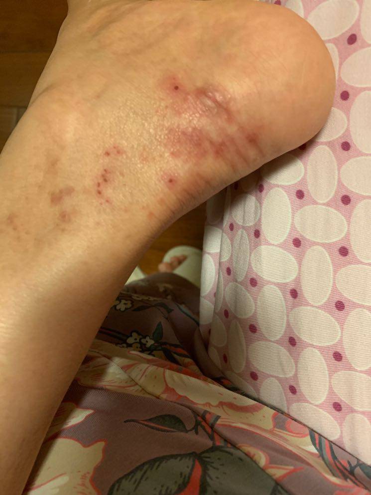 化疗后脚上长了这个,不知道是神经性皮炎还是过敏,有同样经历的姐妹吗