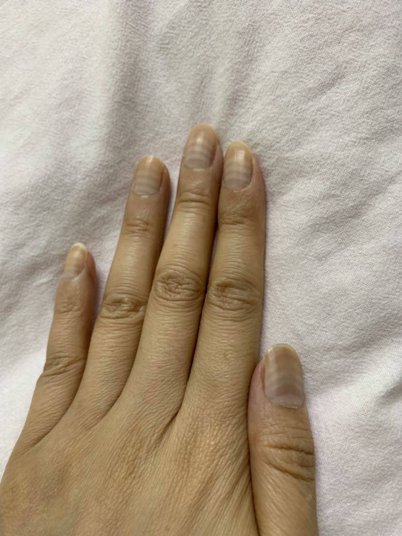 化疗后的指甲