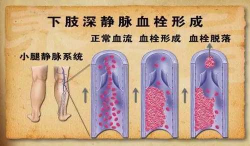 术后护理之如何预防下肢静脉血栓