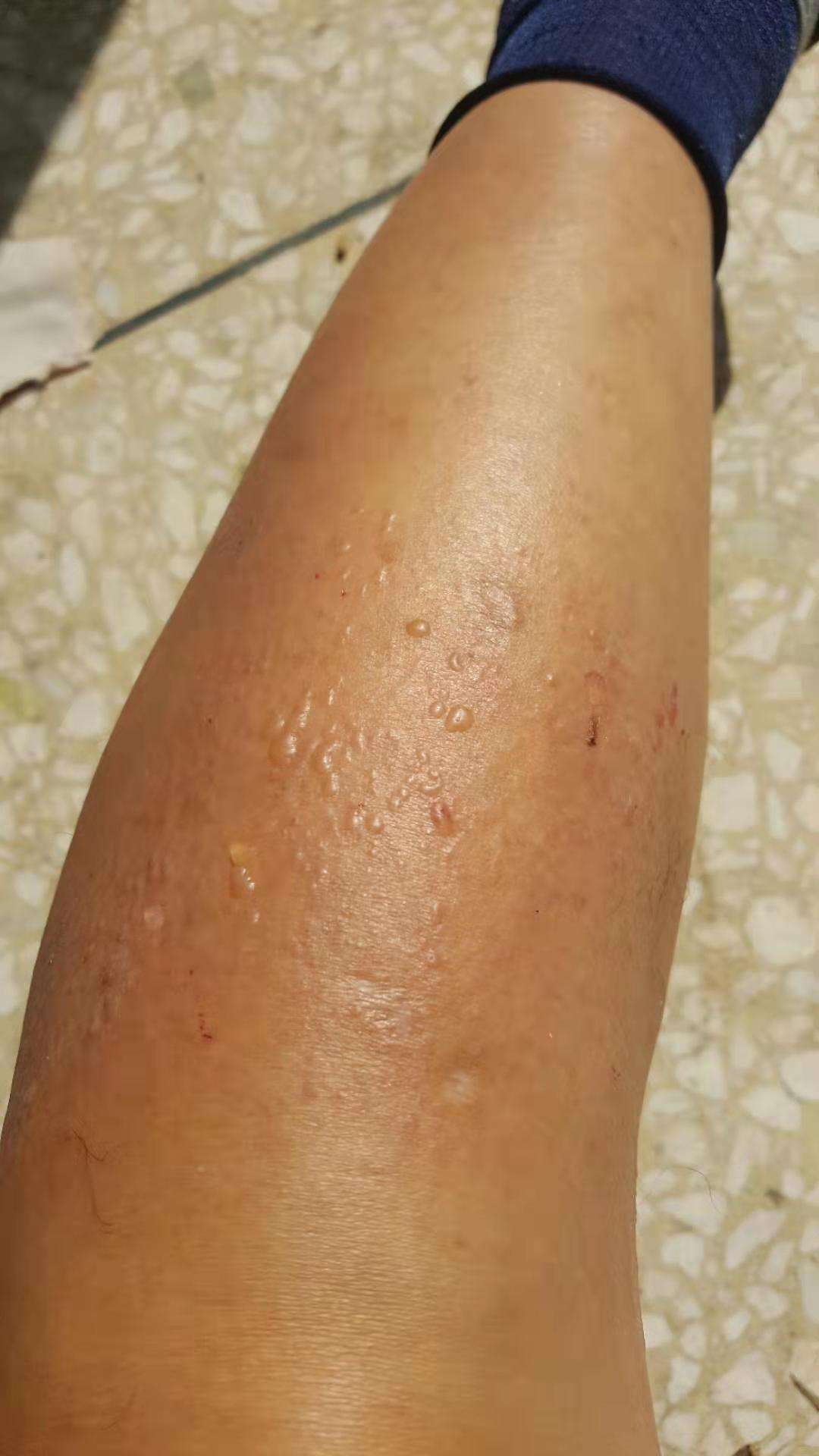 紫杉醇白蛋白结合k药用药后腿上起水泡