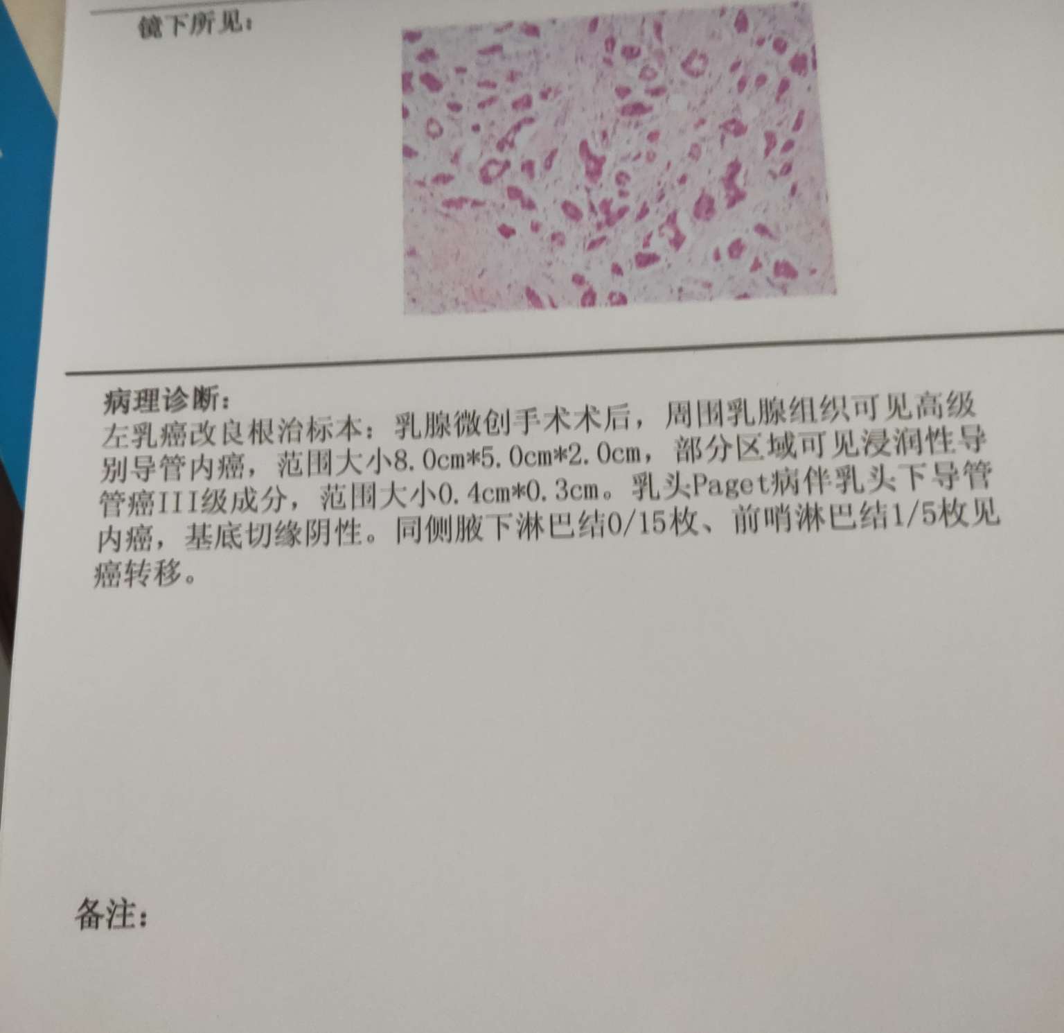 乳腺纤维瘤病理报告图片