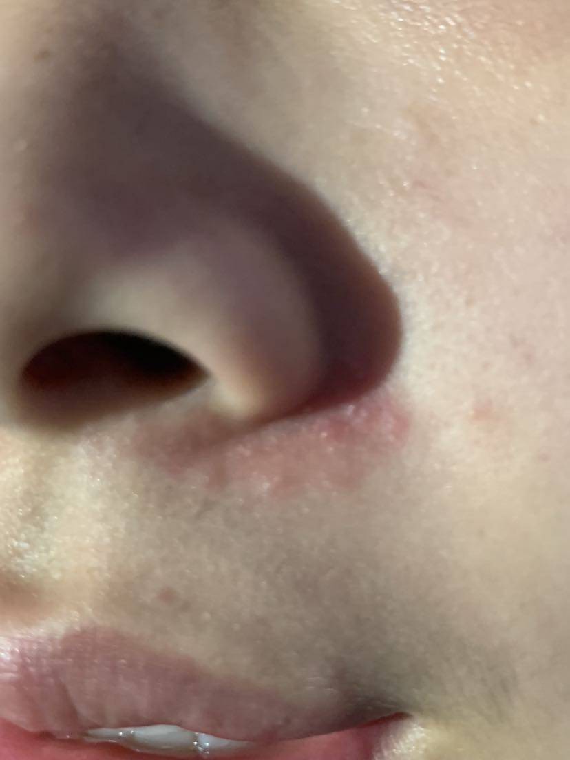 鼻唇沟脂溢性皮炎图片图片