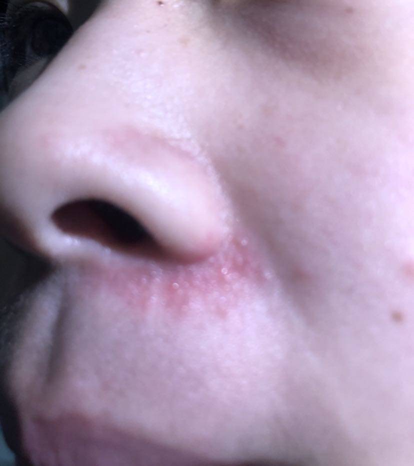鼻沟脂溢性皮炎症状图图片