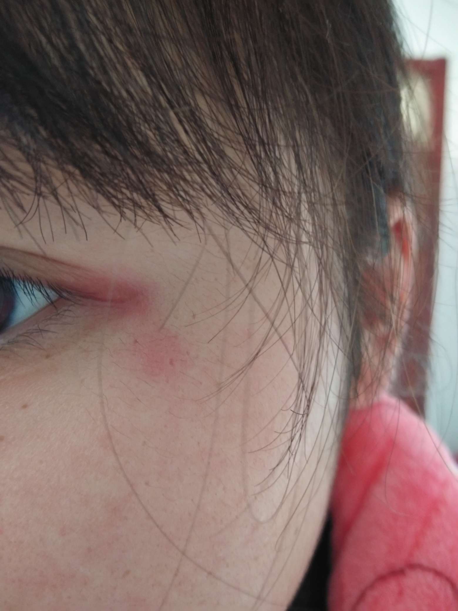 今天早上起来发现眼角这里红红的,不知道怎么回事,有没有狼友知道啊