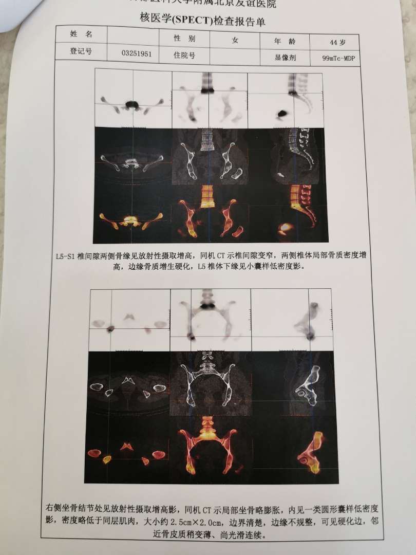 我的骨扫描结果