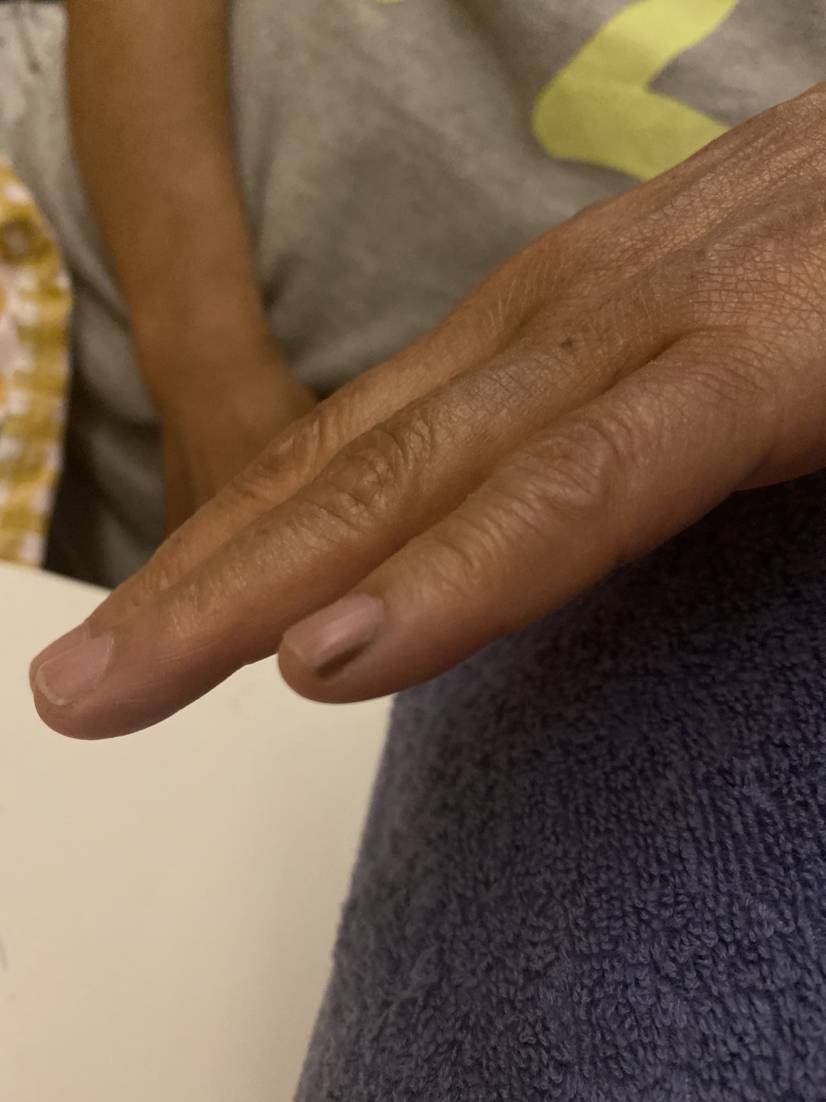 今天一百度,说是黑色素瘤的可能,给我吓不行了,请问一下大家,你们吃来