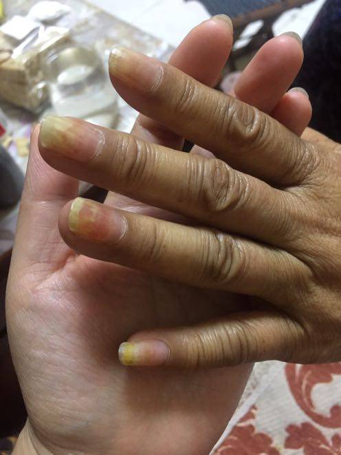 化疗已经七个疗程了用的单药白蛋白紫杉醇前六个是用的进口药后