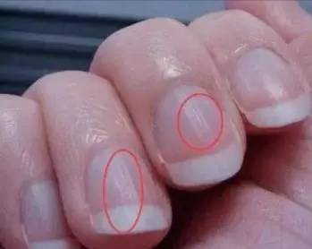 癌症患者化疗后指甲变薄,开裂怎么办?