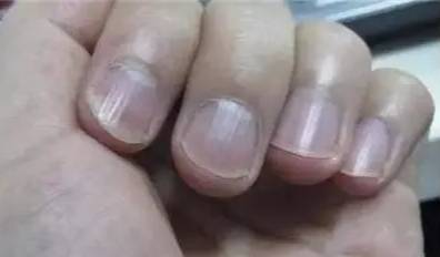 癌症患者化疗后指甲变薄,开裂怎么办?