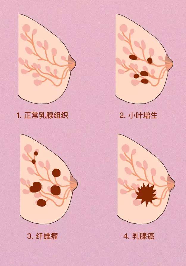 乳房小结节图片