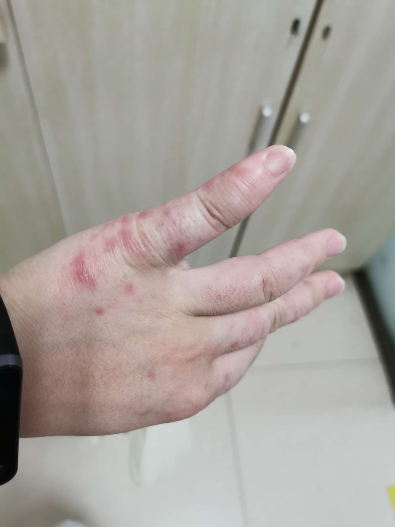 狼疮肾炎-系统性红斑狼疮康复圈-觅健