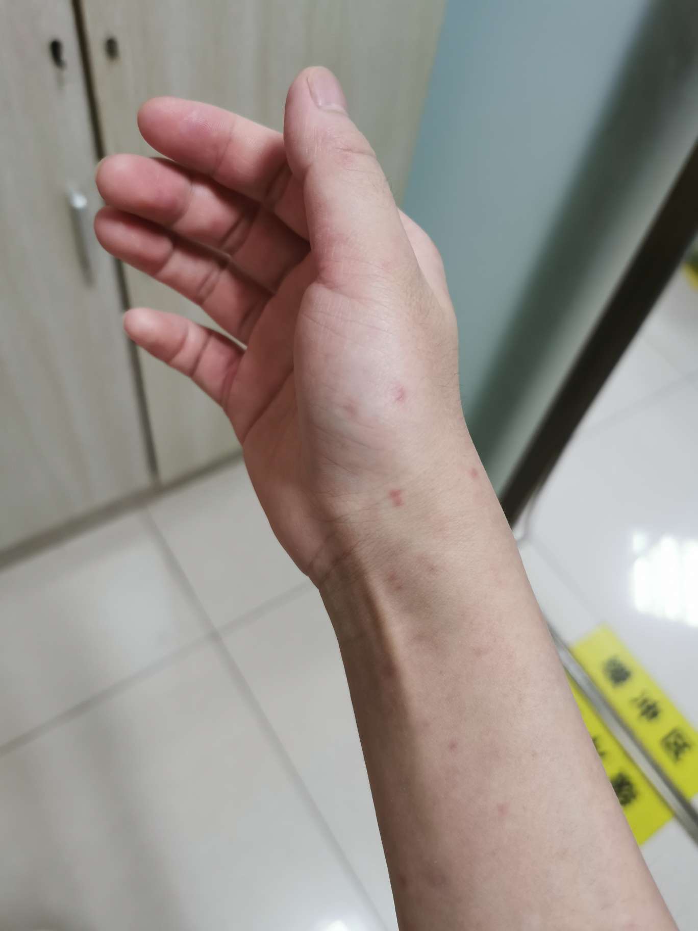 狼疮肾炎-系统性红斑狼疮康复圈-觅健