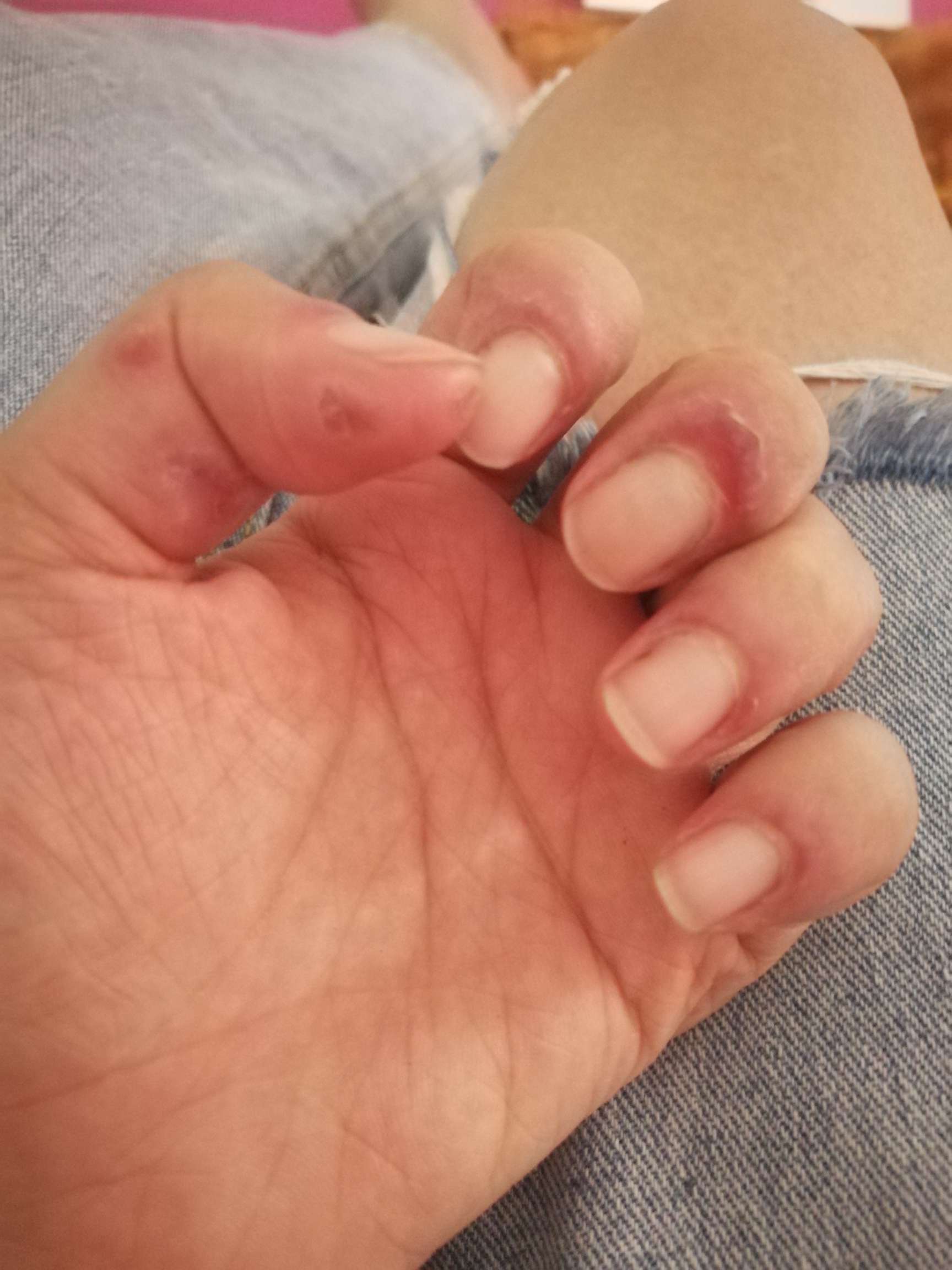 顽固皮疹该用什么药手都不能看了