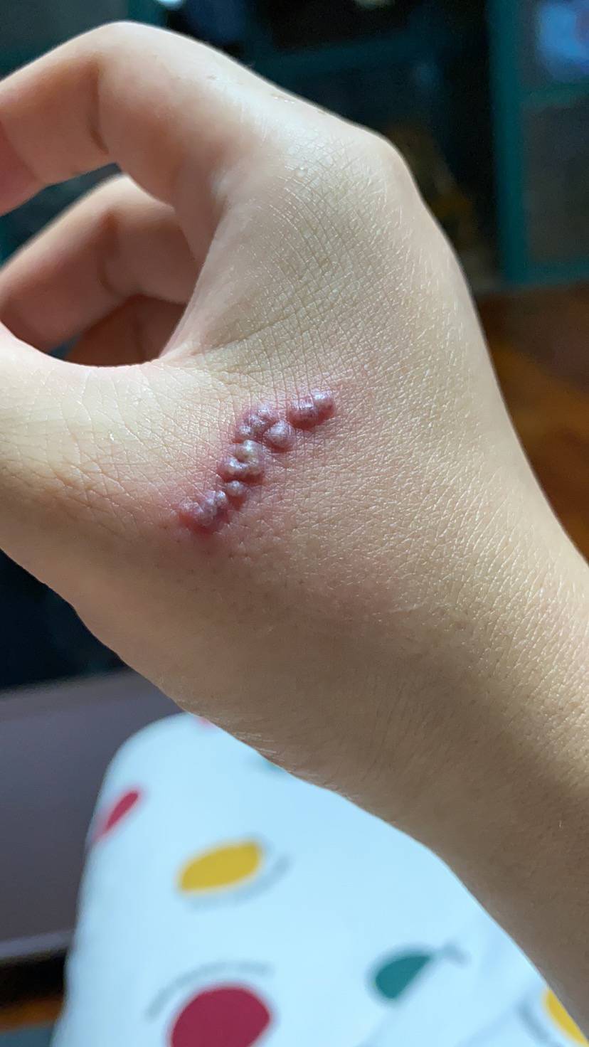 请问下手上长这个泡是什么原因呢