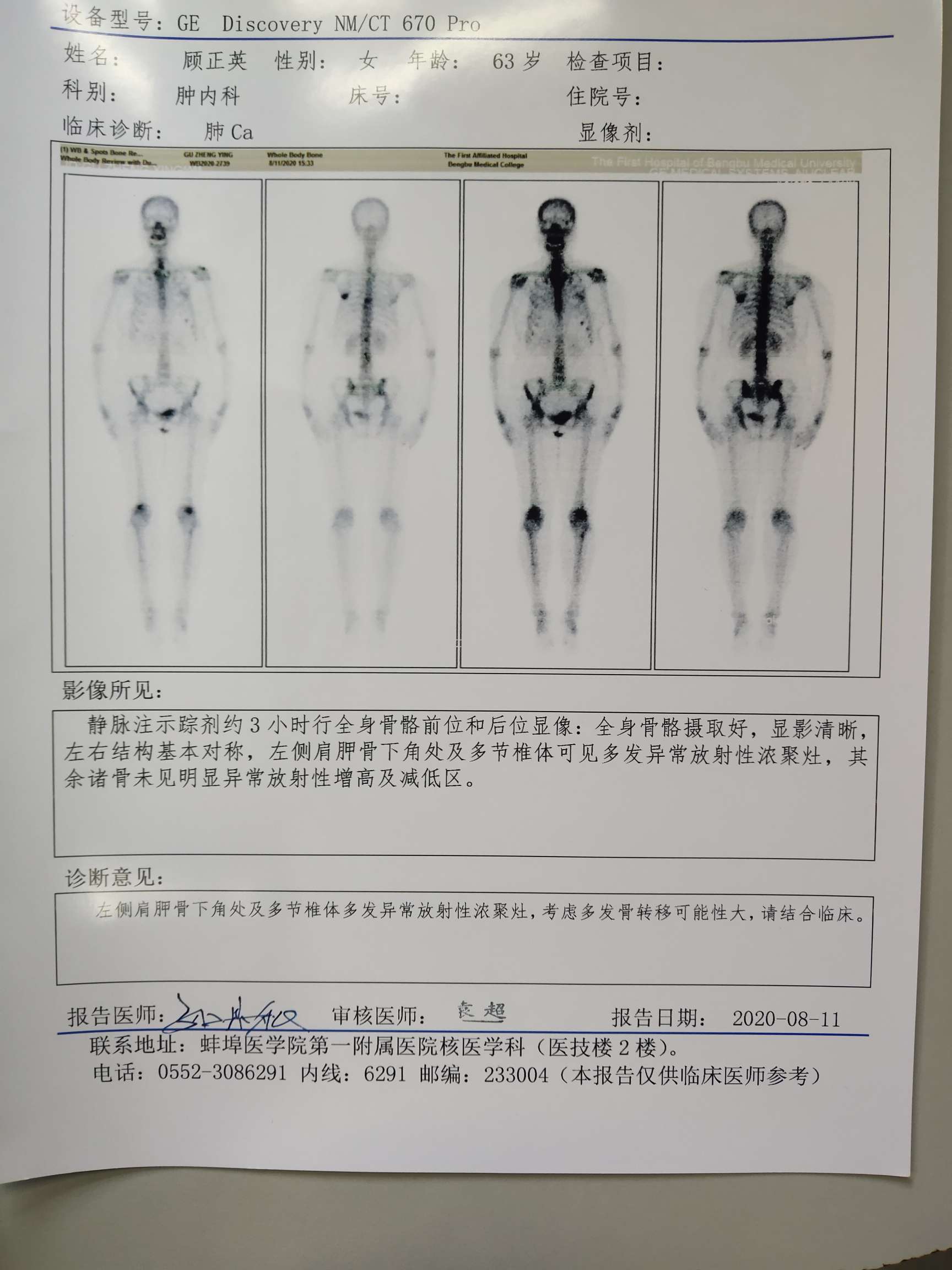 用药2个月后复查,有骨转,求下步治疗方案-肺癌康复圈-觅健