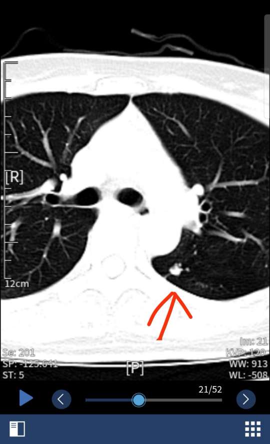 乳腺癌 肺小结节可能转移