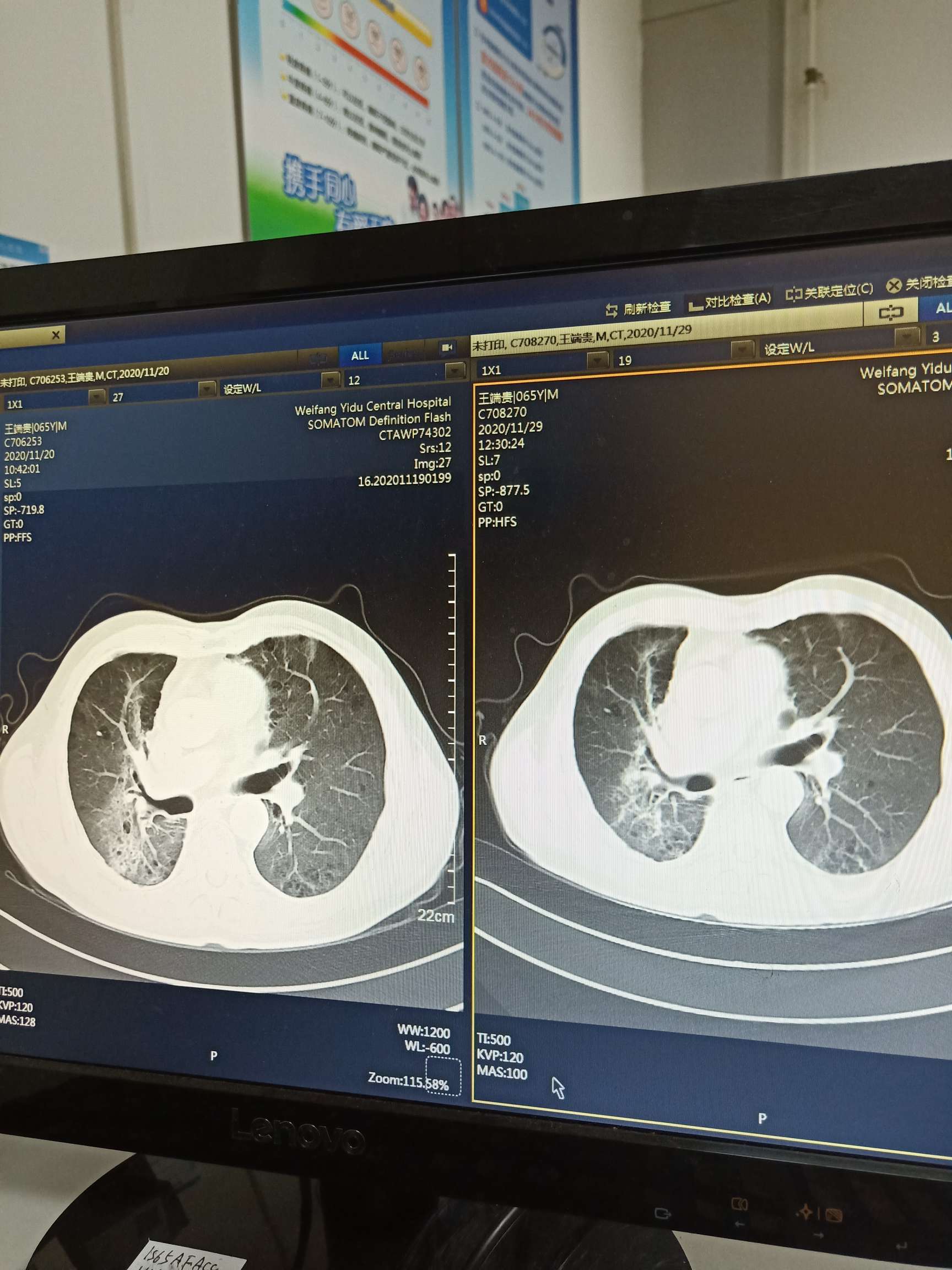_正常肺部与肺纤维化X线对比图片_有来医生