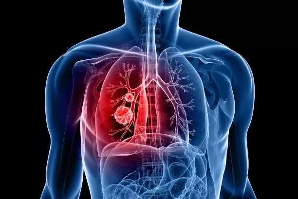 胸部ct查出肺结节,切还是不切?-乳腺癌康复圈-觅健