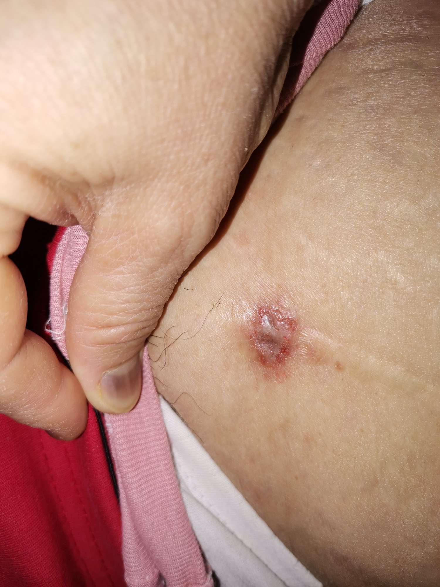 肝癌晚期皮肤溃烂图片图片