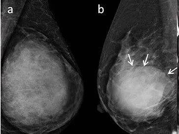 乳腺叶状肿瘤图片