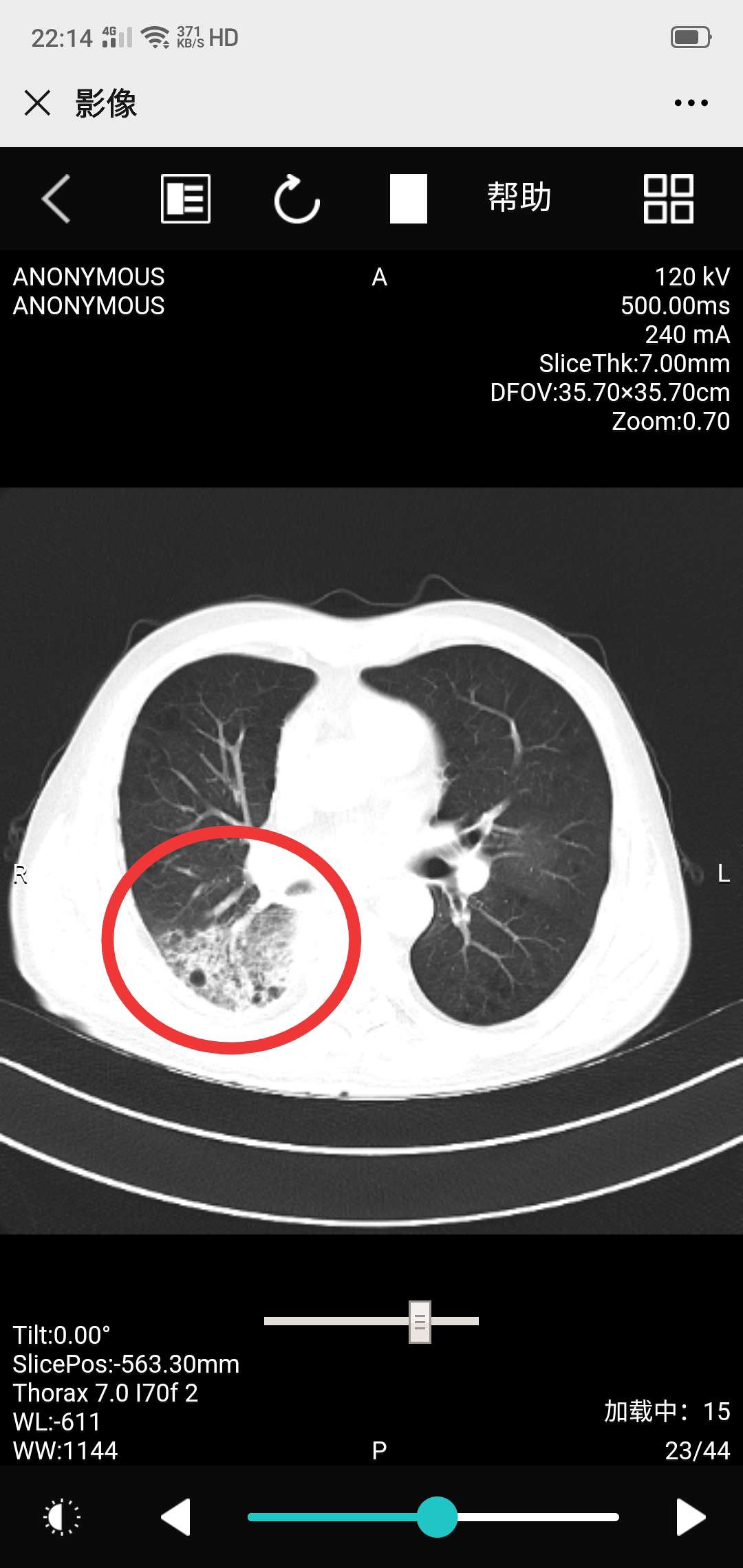 肺炎片子图片及解说图片