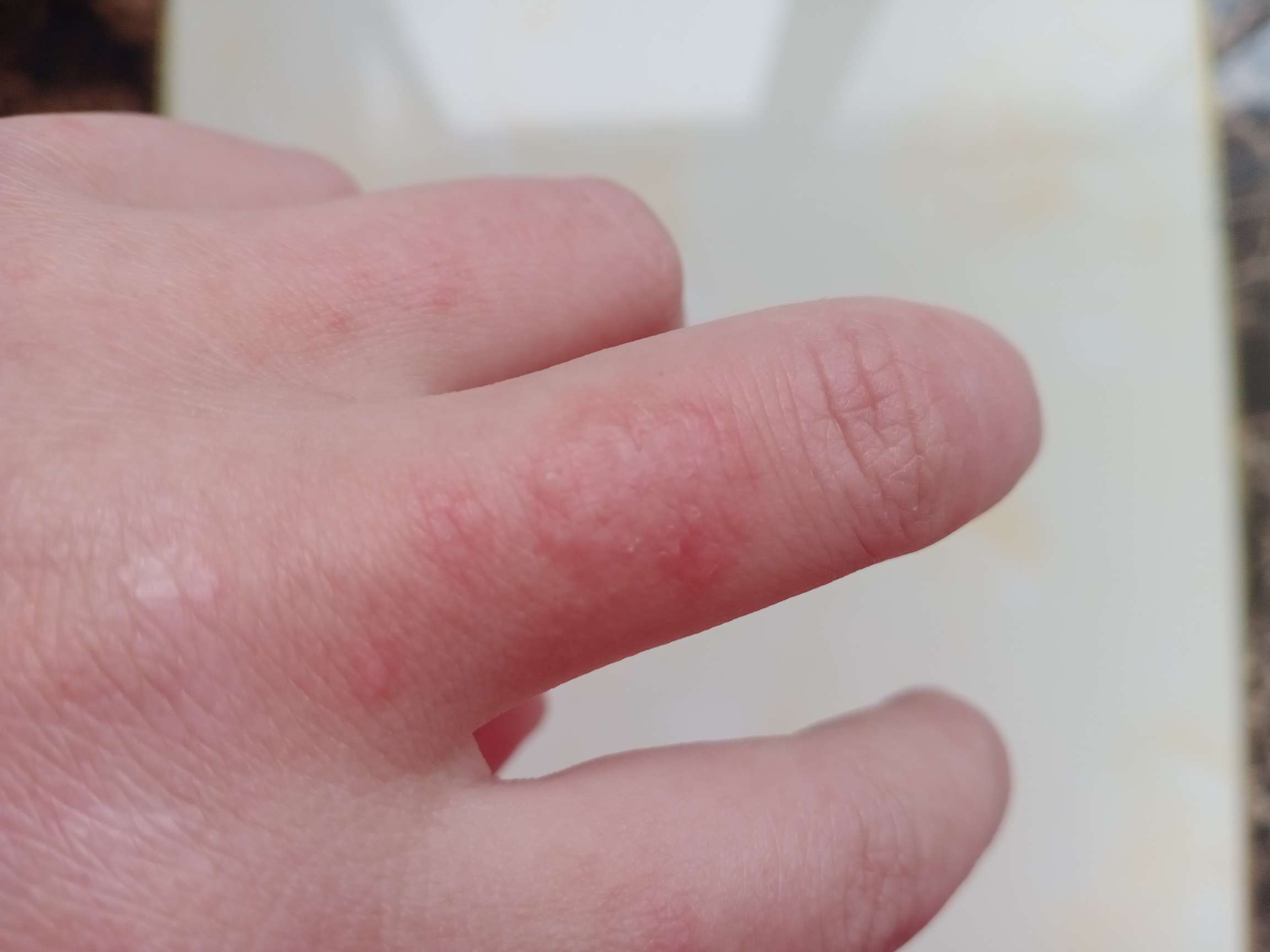 手指上起的这东西有人起过吗是红斑吗摸上去有那种小水泡的感觉
