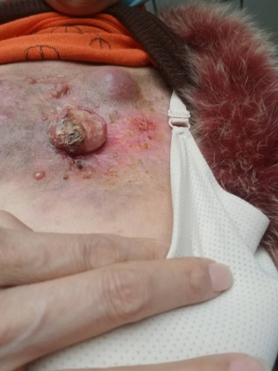 发炎性乳腺癌初期图片图片