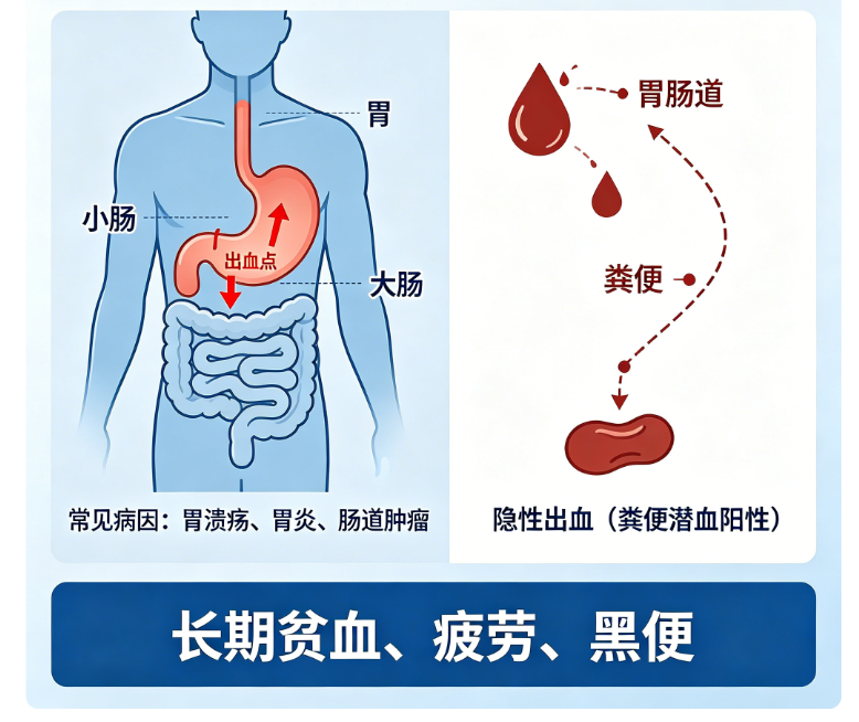 破解慢性失血引发的“隐秘贫血”——顶俏蛋白琥珀酸铁口服溶液为缺铁性贫血患者点亮希望