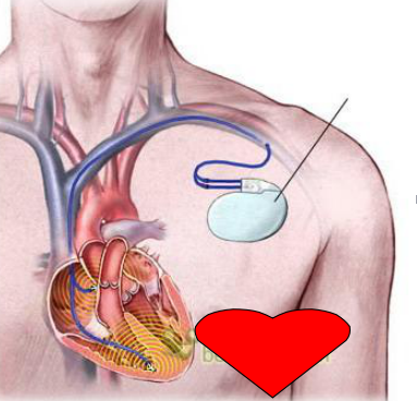 1467783355962813.png 心脏起搏器.png